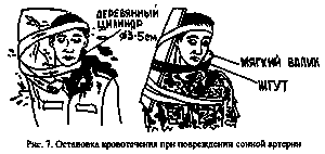 Наложение жгута мочь